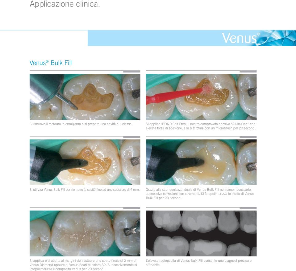 Si utilizza Venus Bulk Fill per riempire la cavità fino ad uno spessore di 4 mm. Grazie alla scorrevolezza ideale di Venus Bulk Fill non sono necessarie successive correzioni con strumenti.