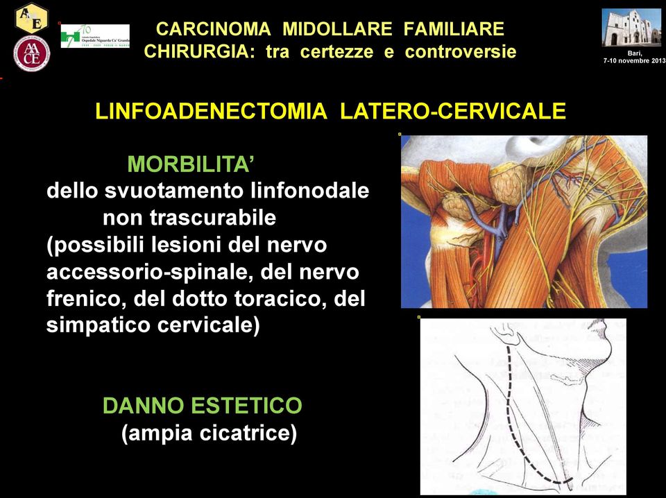 lesioni del nervo accessorio-spinale, del nervo frenico,