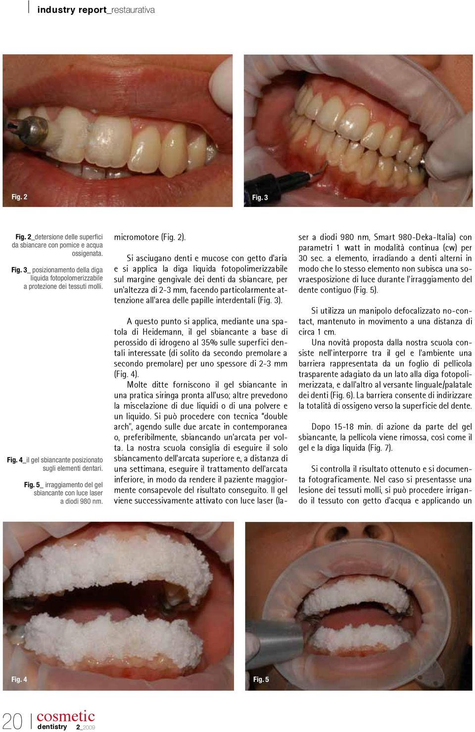 Si asciugano denti e mucose con getto d aria e si applica la diga liquida fotopolimerizzabile sul margine gengivale dei denti da sbiancare, per un altezza di 2-3 mm, facendo particolarmente