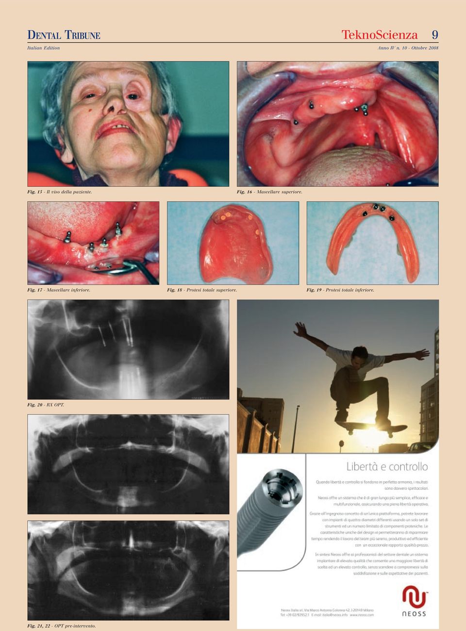 18 - Protesi totale superiore. Fig.