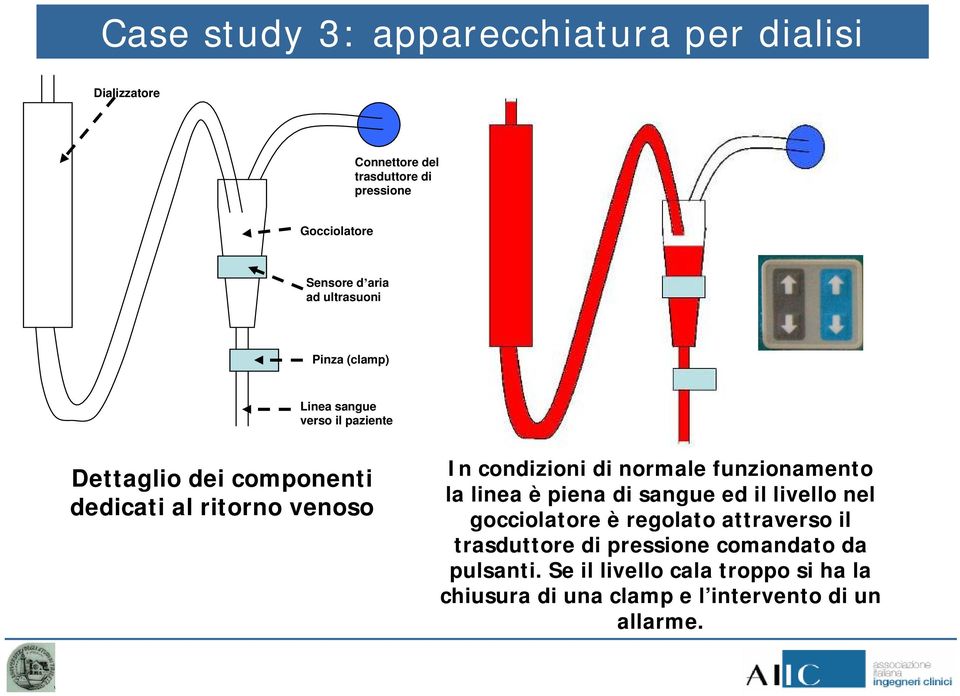 condizioni di normale funzionamento la linea è piena di sangue ed il livello nel gocciolatore è regolato attraverso il