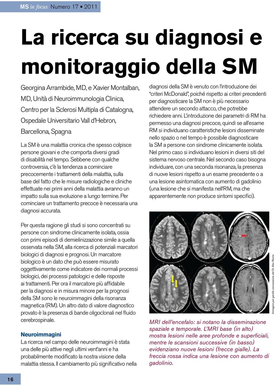 Sebbene con qualche controversia, c è la tendenza a cominciare precocemente i trattamenti della malattia, sulla base del fatto che le misure radiologiche e cliniche effettuate nei primi anni della