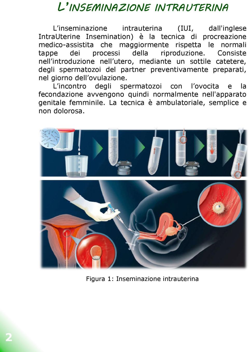 Consiste nell introduzione nell utero, mediante un sottile catetere, degli spermatozoi del partner preventivamente preparati, preparat nel giorno dell