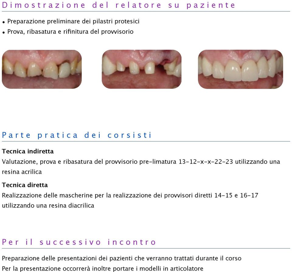 Realizzazione delle mascherine per la realizzazione dei provvisori diretti 14-15 e 16-17 utilizzando una resina diacrilica Per il successivo incontro