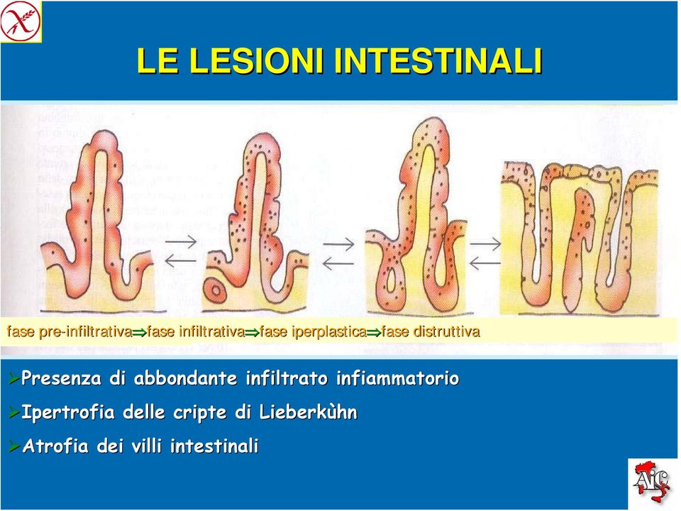 distruttiva Presenza di abbondante infiltrato infiammatorio