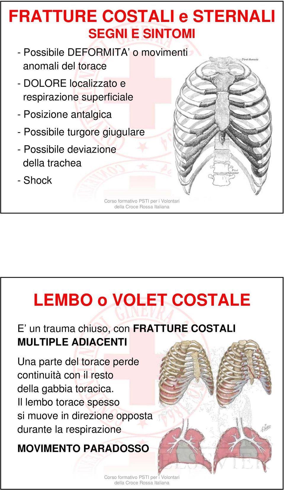 LEMBO o VOLET COSTALE E un trauma chiuso, con FRATTURE COSTALI MULTIPLE ADIACENTI Una parte del torace perde continuità con