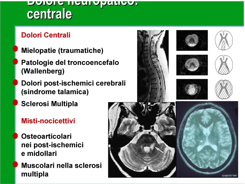 cerebrali (sindrome talamica) Sclerosi Multipla Misti-nocicettivi
