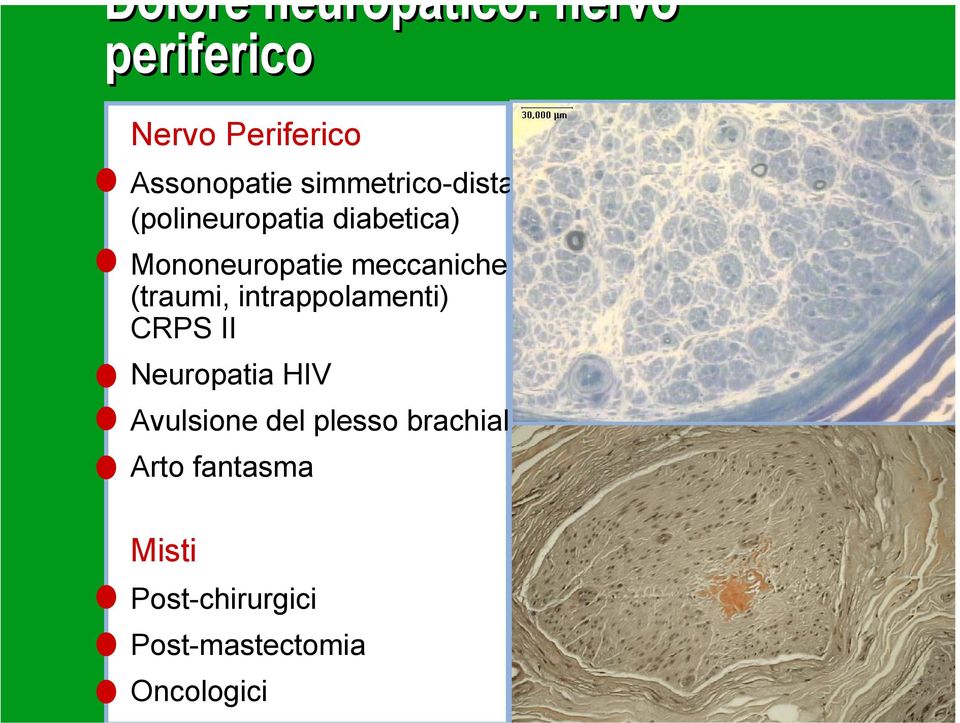 meccaniche (traumi, intrappolamenti) CRPS II Neuropatia HIV Avulsione