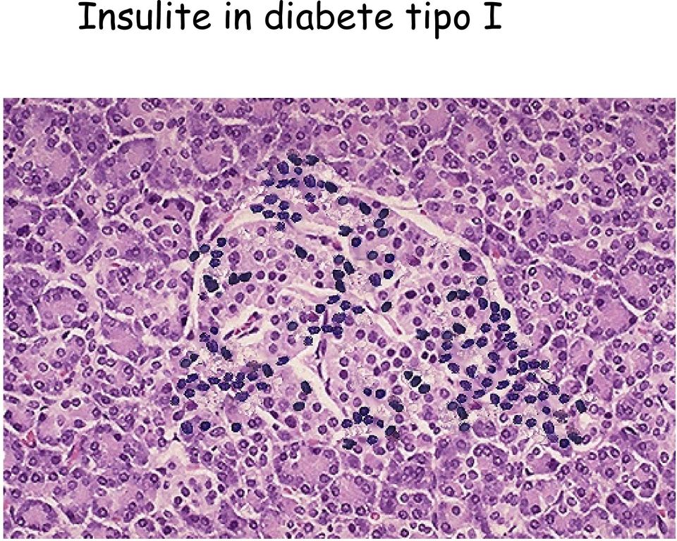 diabete