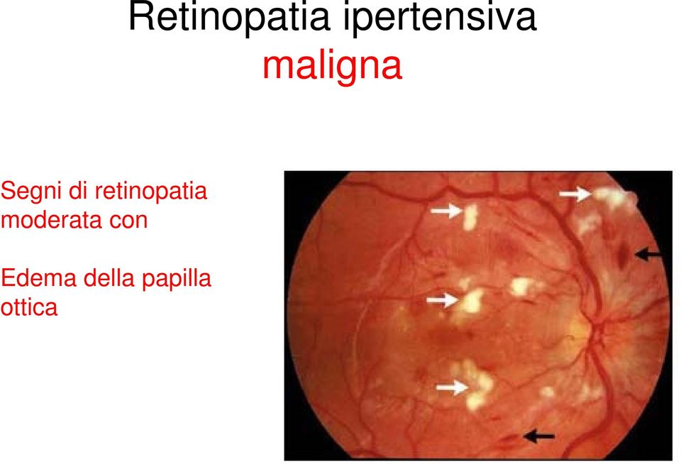 Segni di retinopatia