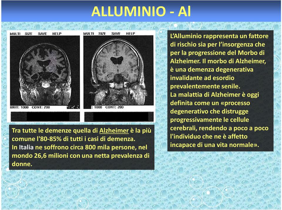 L Alluminio rappresenta un fattore di rischio sia per l insorgenza che per la progressione del Morbo di Alzheimer.