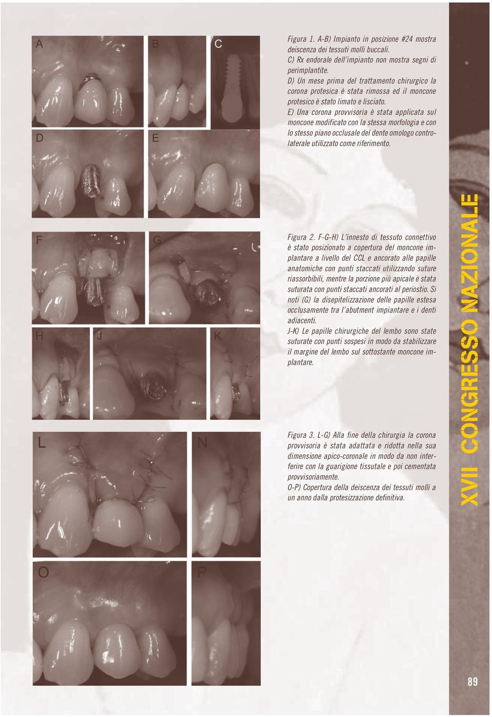 E) Una corona provvisoria è stata applicata sul moncone modificato con la stessa morfologia e con lo stesso piano occlusale del dente omologo controlaterale utilizzato come riferimento. Figura 2.