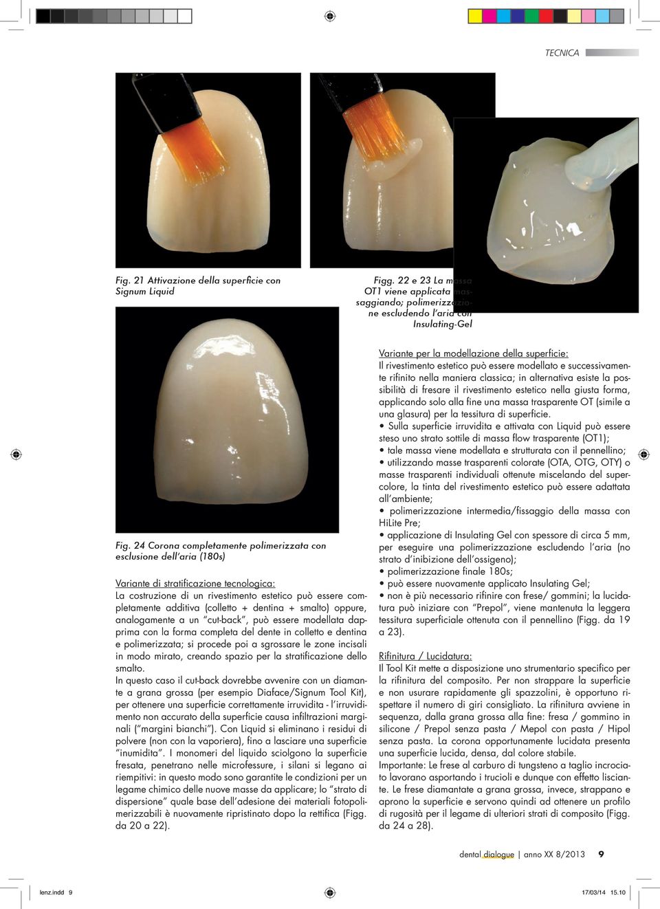 dentina + smalto) oppure, analogamente a un cut-back, può essere modellata dapprima con la forma completa del dente in colletto e dentina e polimerizzata; si procede poi a sgrossare le zone incisali