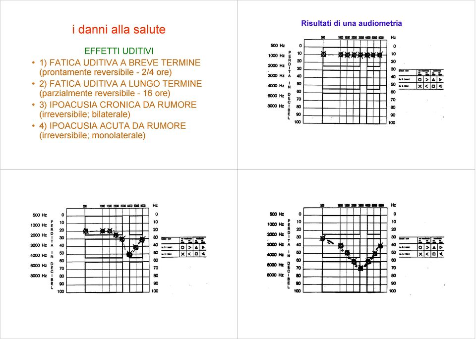 LUNGO TERMINE (parzialmente reversibile - 16 ore) 3) IPOACUSIA CRONICA DA RUMORE