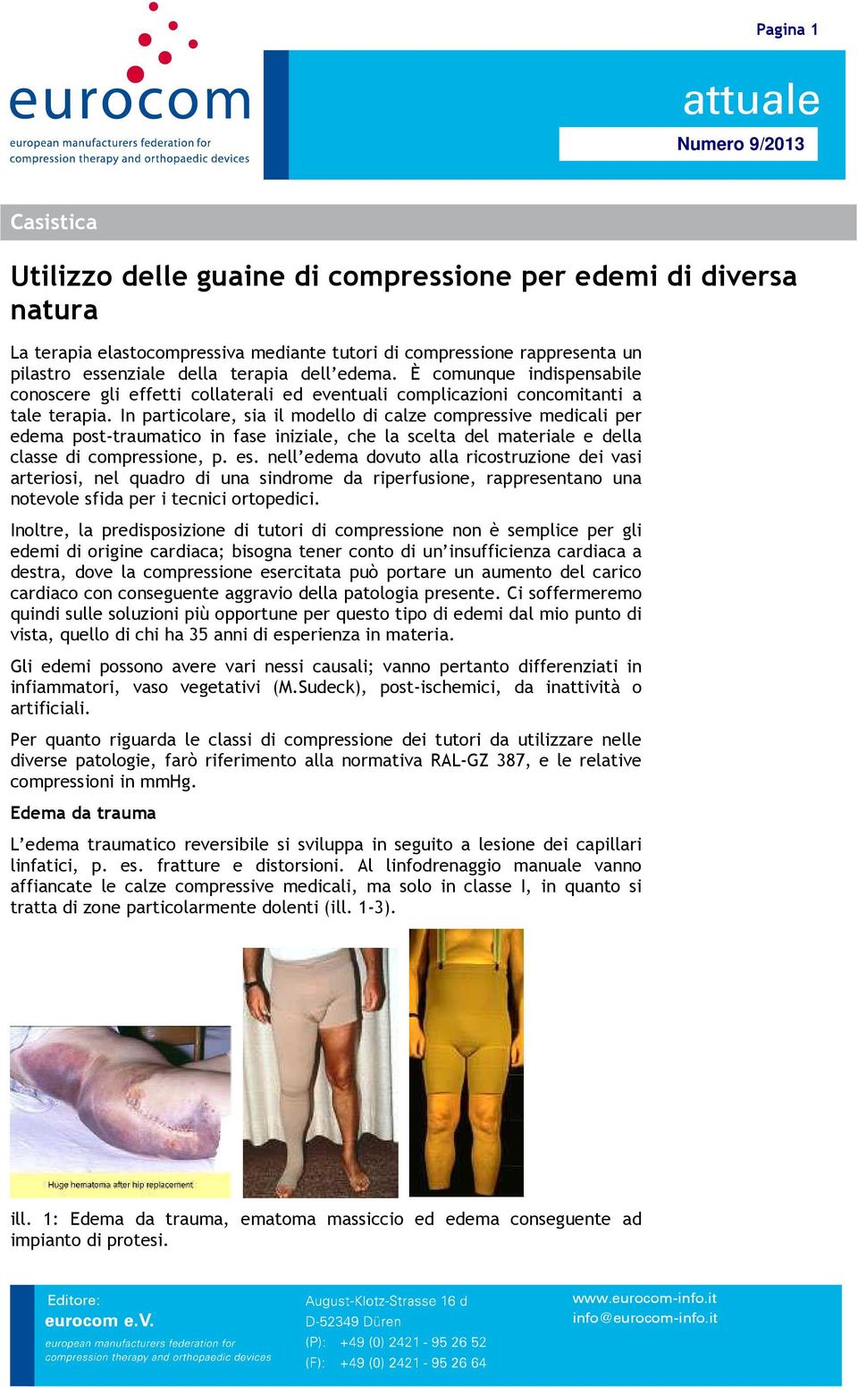 In particolare, sia il modello di calze compressive medicali per edema post-traumatico in fase iniziale, che la scelta del materiale e della classe di compressione, p. es.