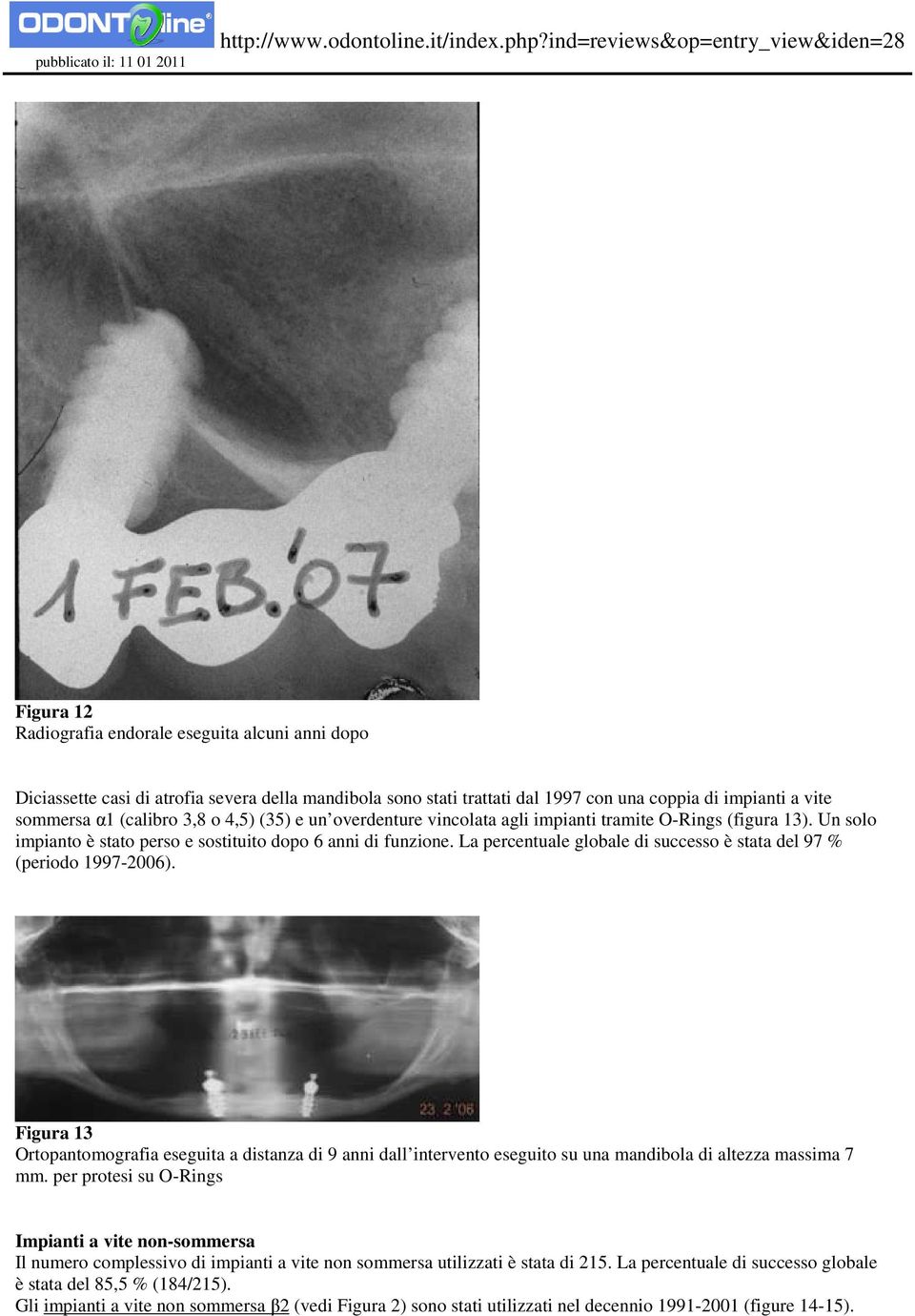 La percentuale globale di successo è stata del 97 % (periodo 1997-2006). Figura 13 Ortopantomografia eseguita a distanza di 9 anni dall intervento eseguito su una mandibola di altezza massima 7 mm.
