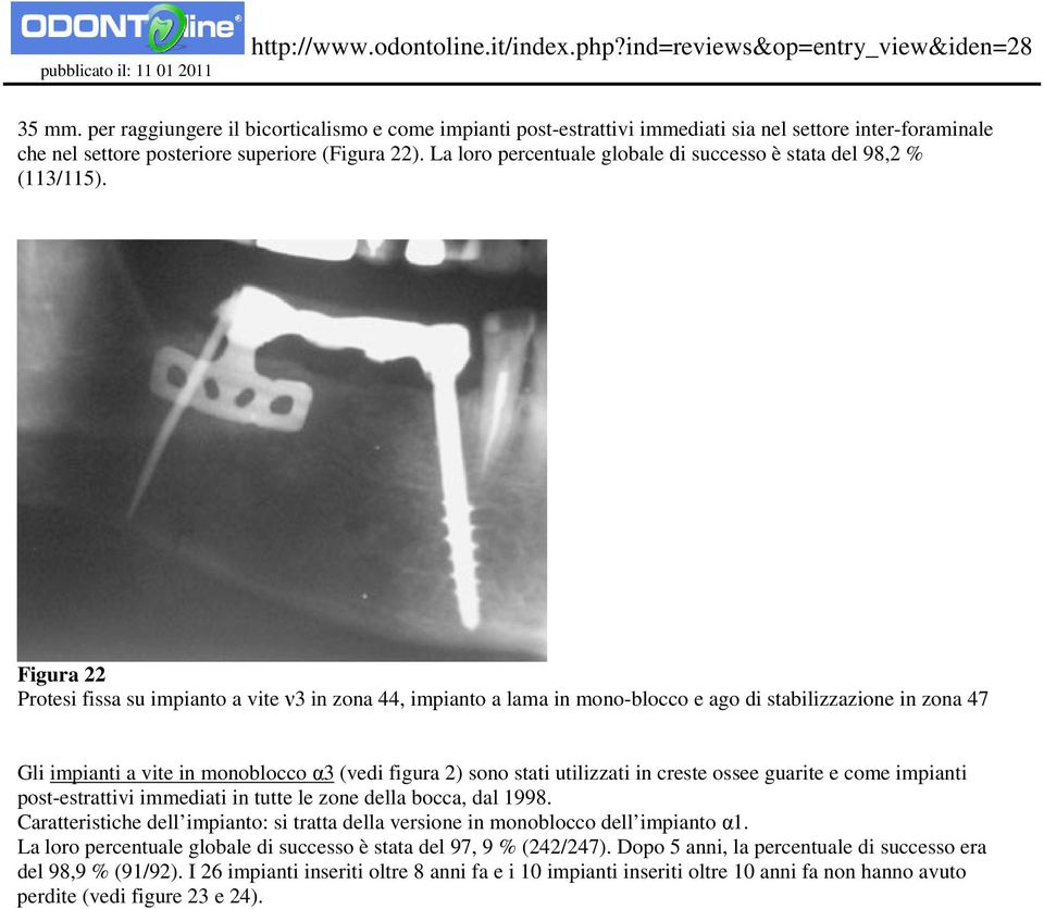 Figura 22 Protesi fissa su impianto a vite ν3 in zona 44, impianto a lama in mono-blocco e ago di stabilizzazione in zona 47 Gli impianti a vite in monoblocco α3 (vedi figura 2) sono stati utilizzati