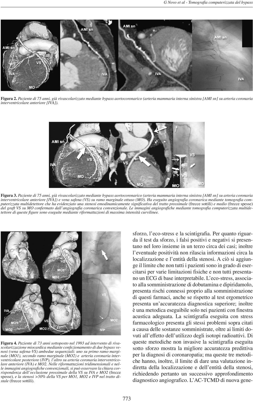 Paziente di 75 anni, già rivascolarizzato mediante bypass aortocoronarico (arteria mammaria interna sinistra [AMI sn] su arteria coronaria interventricolare anteriore [IVA]) e vena safena (VS) su