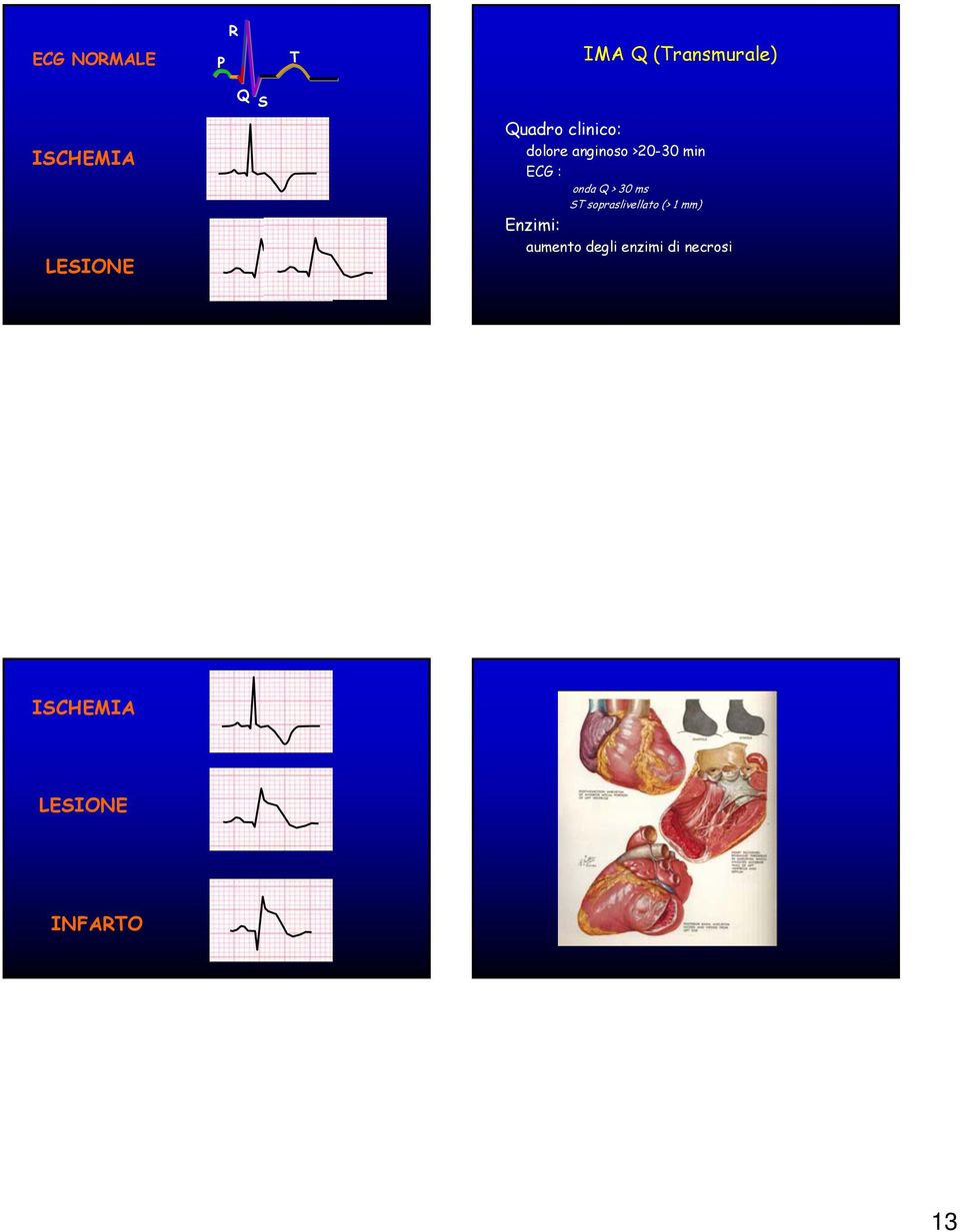 : onda Q > 30 ms ST sopraslivellato (> 1 mm) Enzimi: