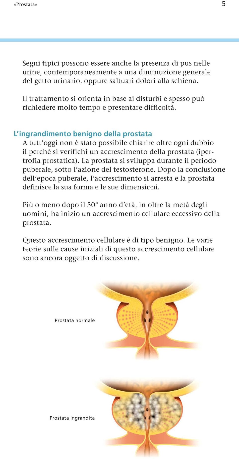 L ingrandimento benigno della prostata A tutt oggi non è stato possibile chiarire oltre ogni dubbio il perché si verifichi un accrescimento della prostata (ipertrofia prostatica).