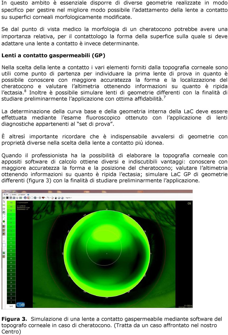 Se dal punto di vista medico la morfologia di un cheratocono potrebbe avere una importanza relativa, per il contattologo la forma della superfice sulla quale si deve adattare una lente a contatto è