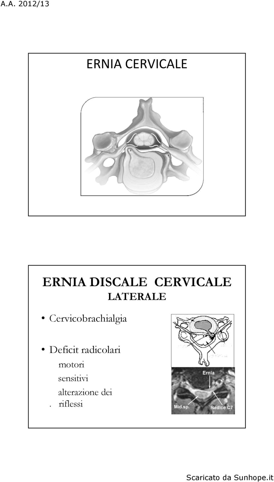 Cervicobrachialgia Deficit