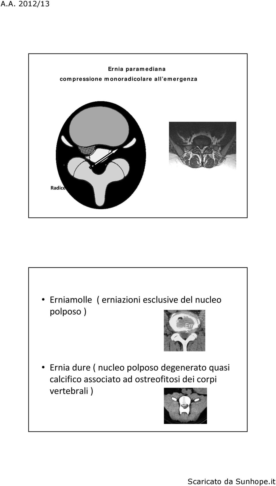 esclusive del nucleo polposo ) Ernia dure ( nucleo polposo