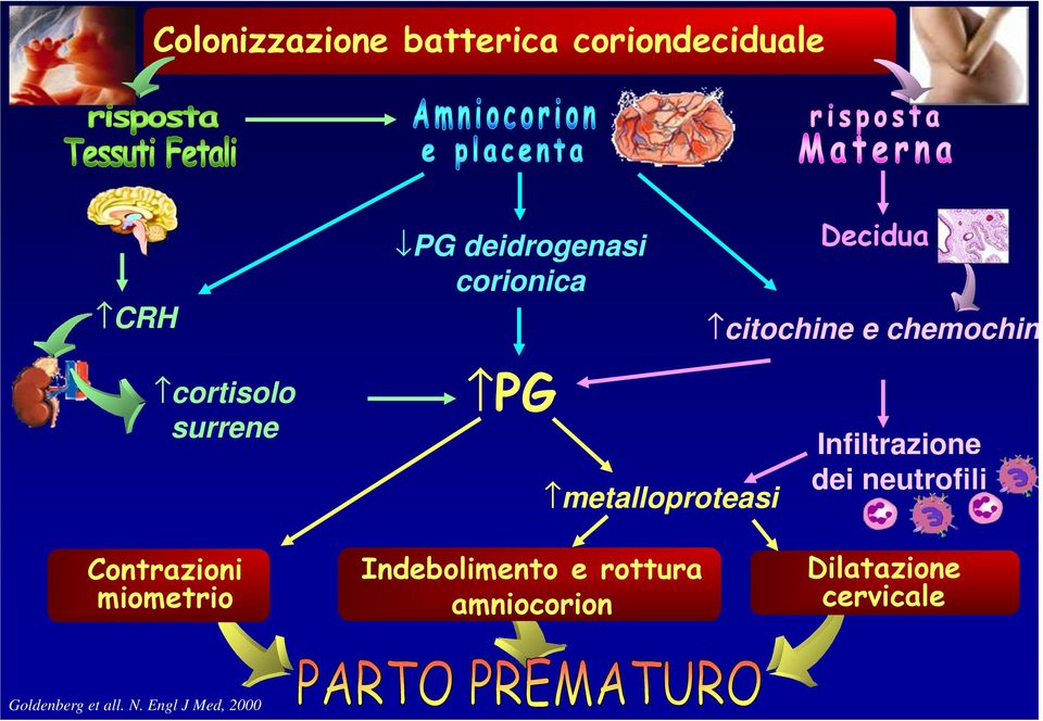 PG metalloproteasi Indebolimento e rottura amniocorion Infiltrazione