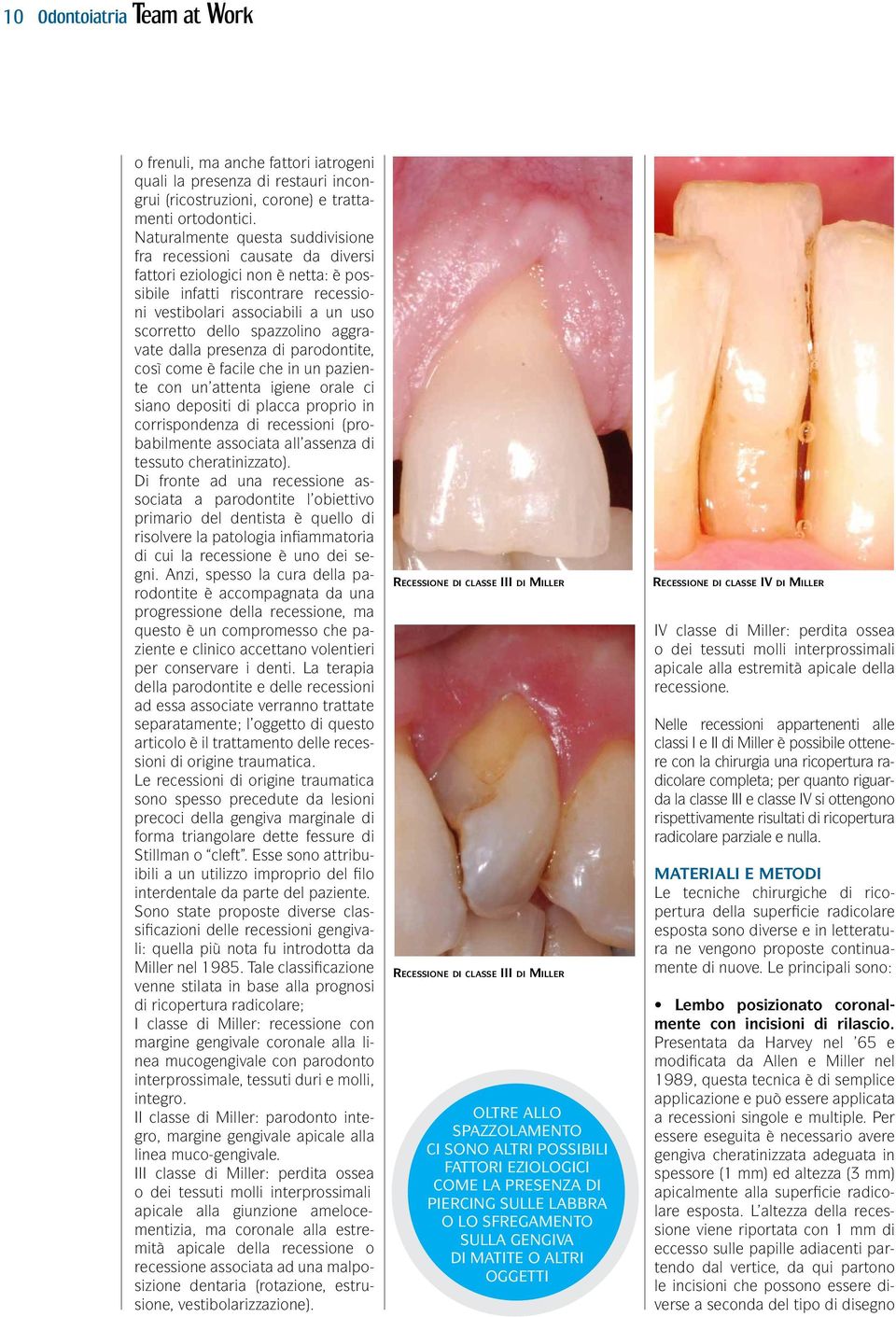 spazzolino aggravate dalla presenza di parodontite, così come è facile che in un paziente con un attenta igiene orale ci siano depositi di placca proprio in corrispondenza di recessioni