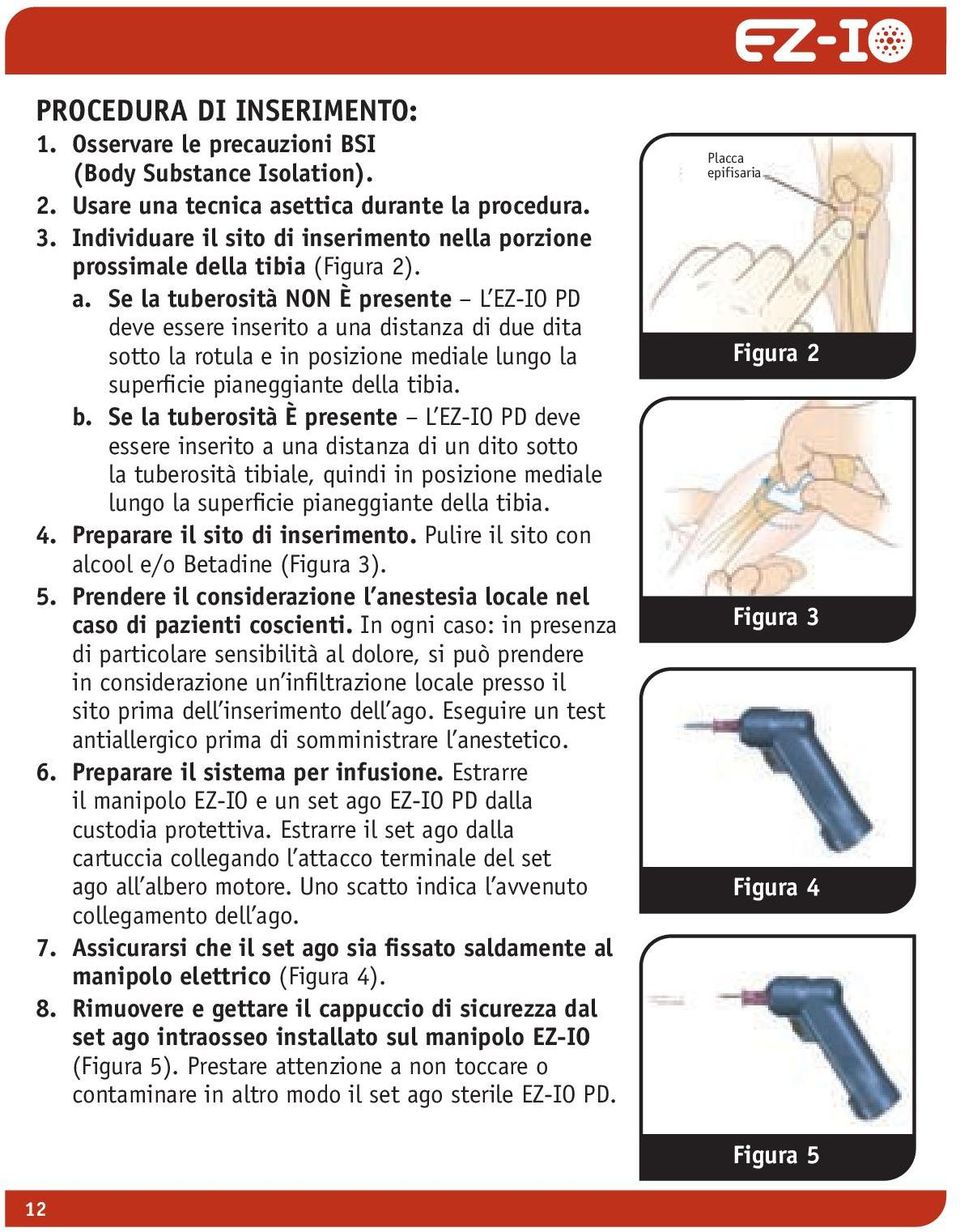 Se la tuberosità NON È presente L EZ-IO PD deve essere inserito a una distanza di due dita sotto la rotula e in posizione mediale lungo la superficie pianeggiante della tibia. b.