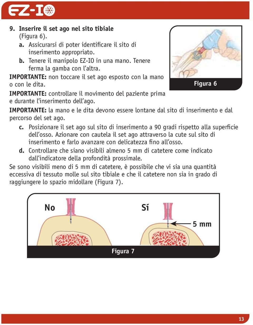 IMPORTANTE: la mano e le dita devono essere lontane dal sito di inserimento e dal percorso del set ago. c. Posizionare il set ago sul sito di inserimento a 90 gradi rispetto alla superficie dell osso.