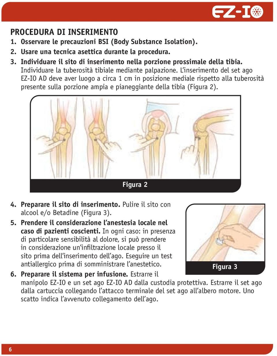 L inserimento del set ago EZ-IO AD deve aver luogo a circa 1 cm in posizione mediale rispetto alla tuberosità presente sulla porzione ampia e pianeggiante della tibia (Figura 2). Figura 2 4.