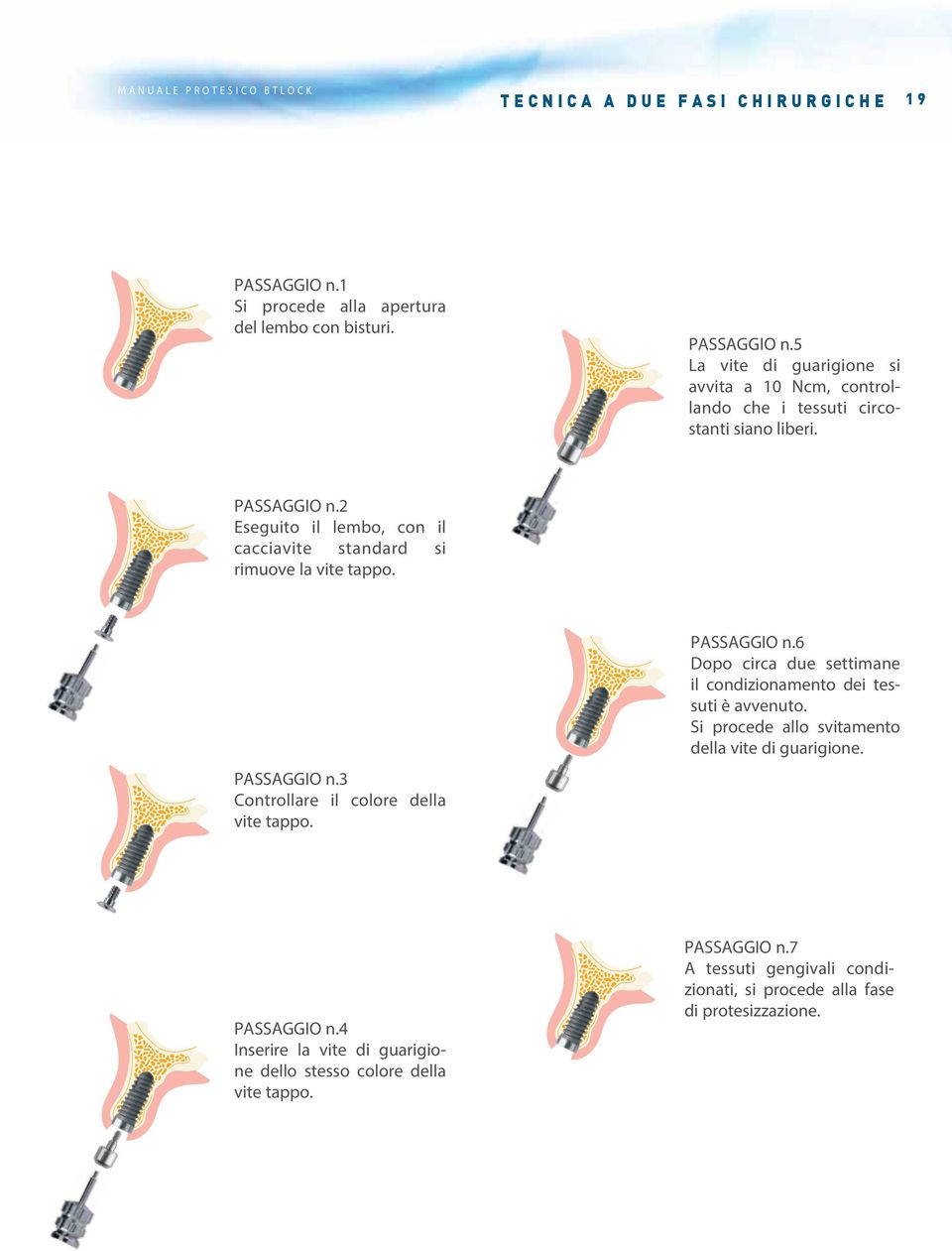 Si procede allo svitamento della vite di guarigione. PASSAGGIO n.4 Inserire la vite di guarigione dello stesso colore della vite tappo. PASSAGGIO n.7 A tessuti gengivali condizionati, si procede alla fase di protesizzazione.