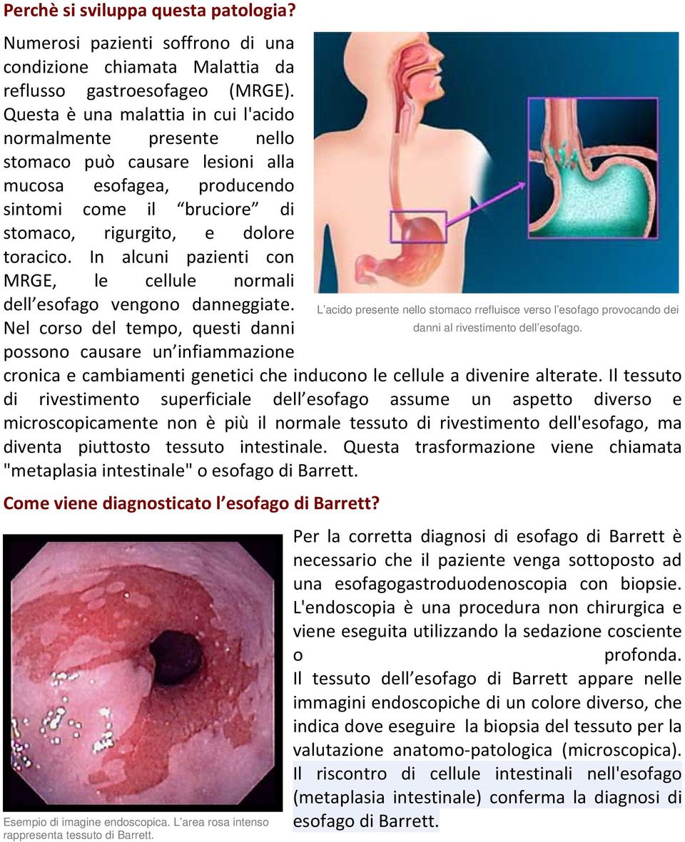 In alcuni pazienti con MRGE, le cellule normali dell esofago vengono danneggiate.