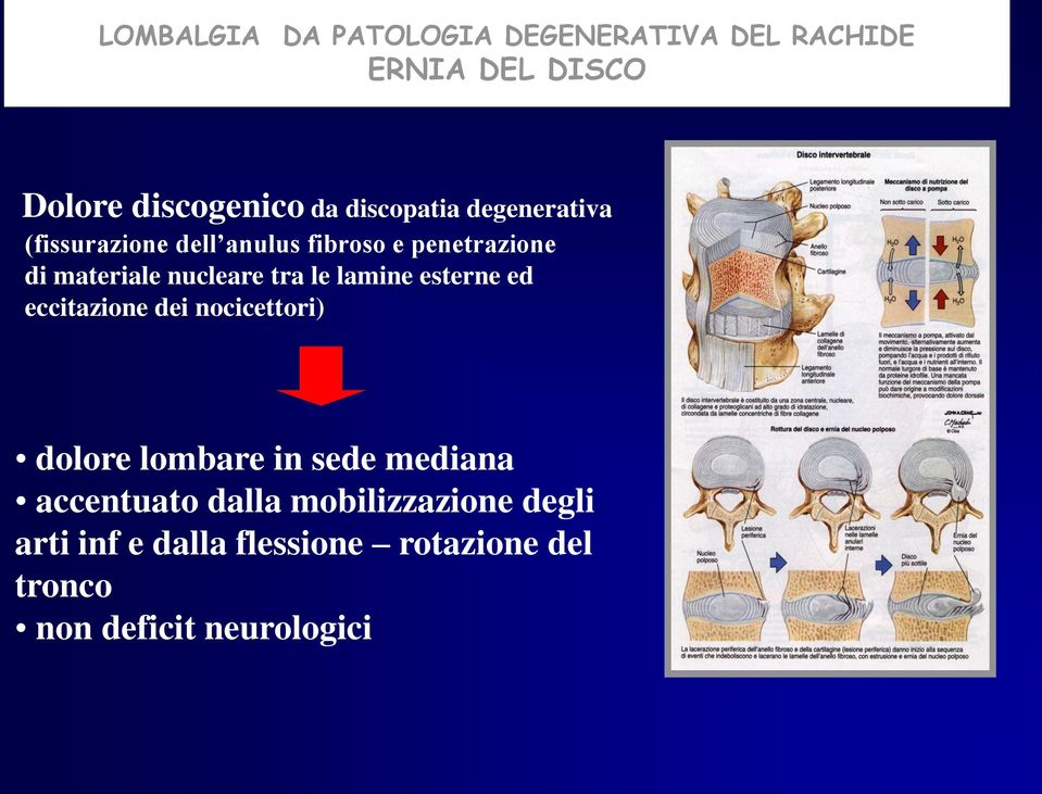 nucleare tra le lamine esterne ed eccitazione dei nocicettori) dolore lombare in sede mediana