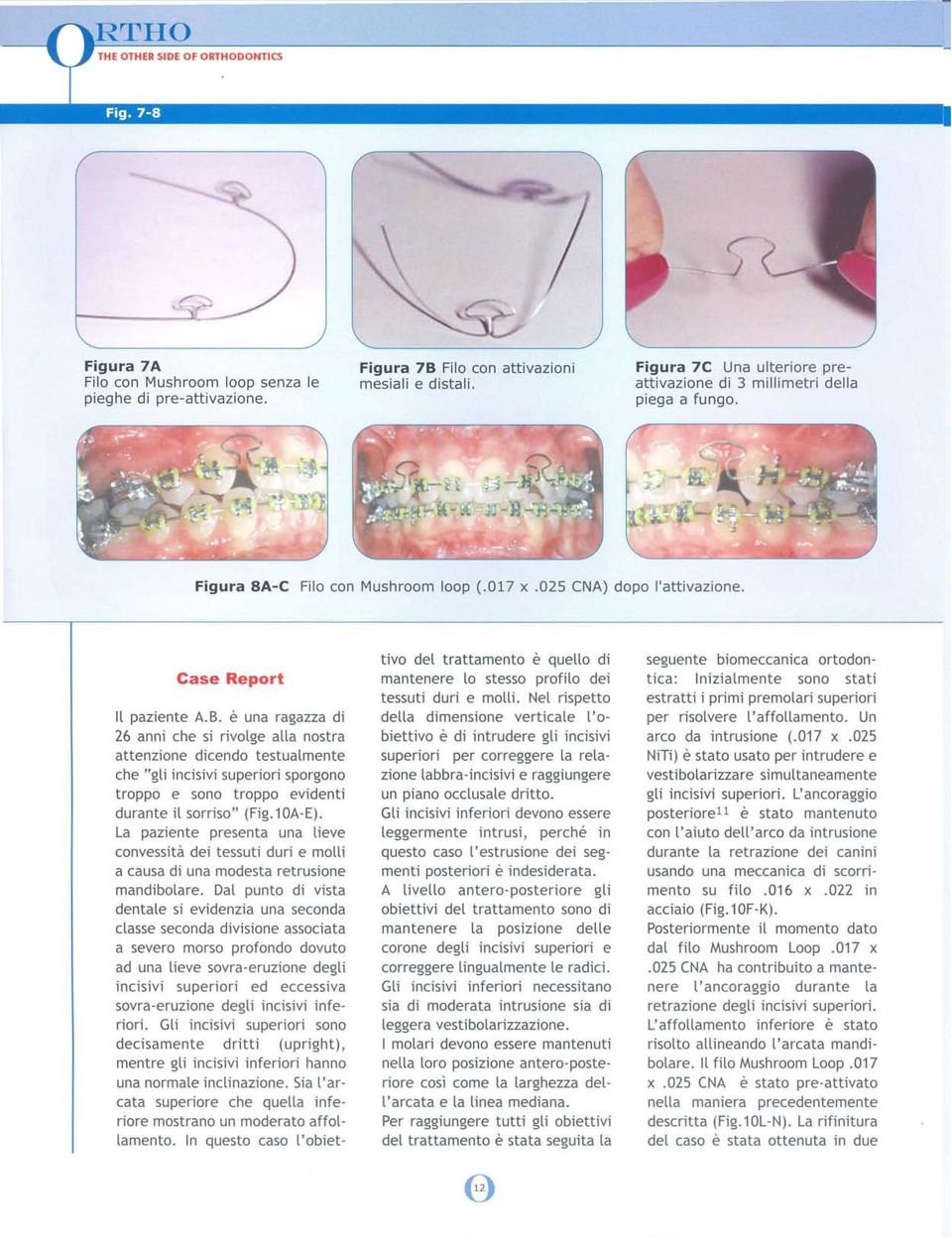 è una ragazza di 26 anni che si rivolge alla nostra attenzione dicendo testualmente che "gli incisivi superiori sporgono troppo e sono troppo evidenti durante il sorriso" (Fig.10A-E).