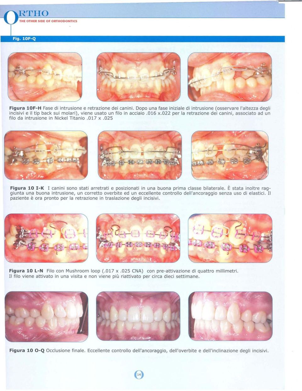 022 per la retrazione dei canini, associato ad un filo da intrusione in Nickel Titanio.017 x.025 Figura 10 I-K I canini sono stati arretrati e posizionati in una buona prima classe bilaterale.