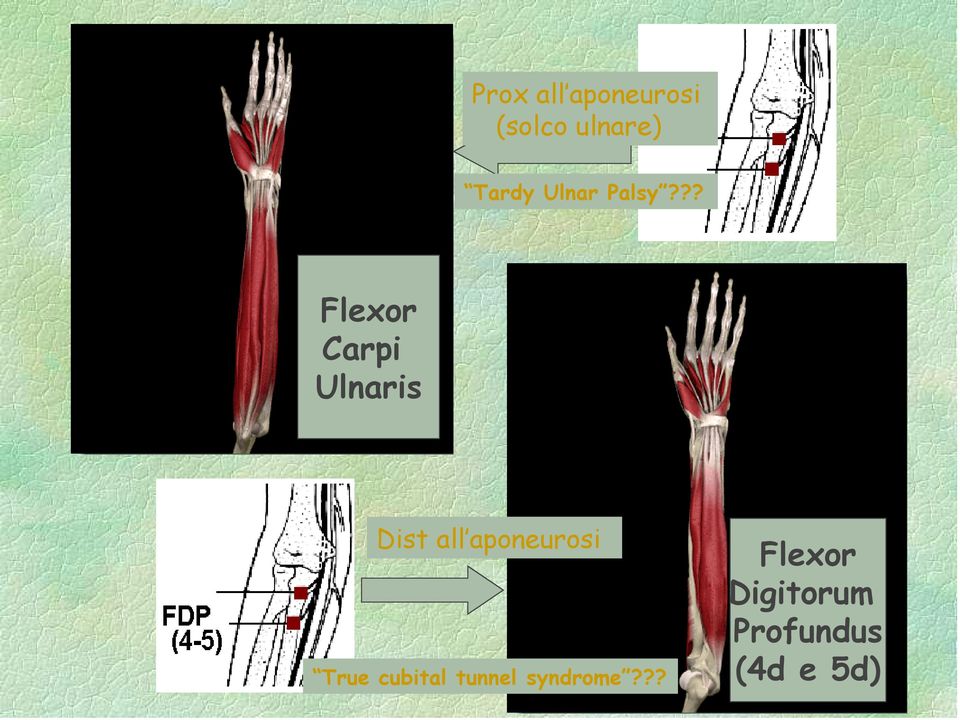 ?? Flexor Carpi Ulnaris Dist all