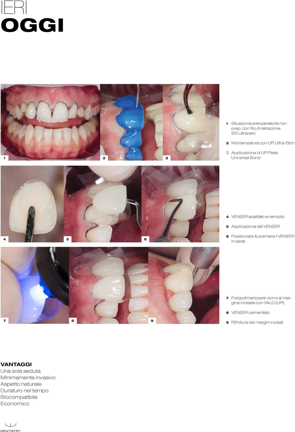 5 Applicazione del VENEER 4 5 6 6 Posizionare & premere il VENEER in sede 7 Fotopolimerizzare vicino al margine incisale con