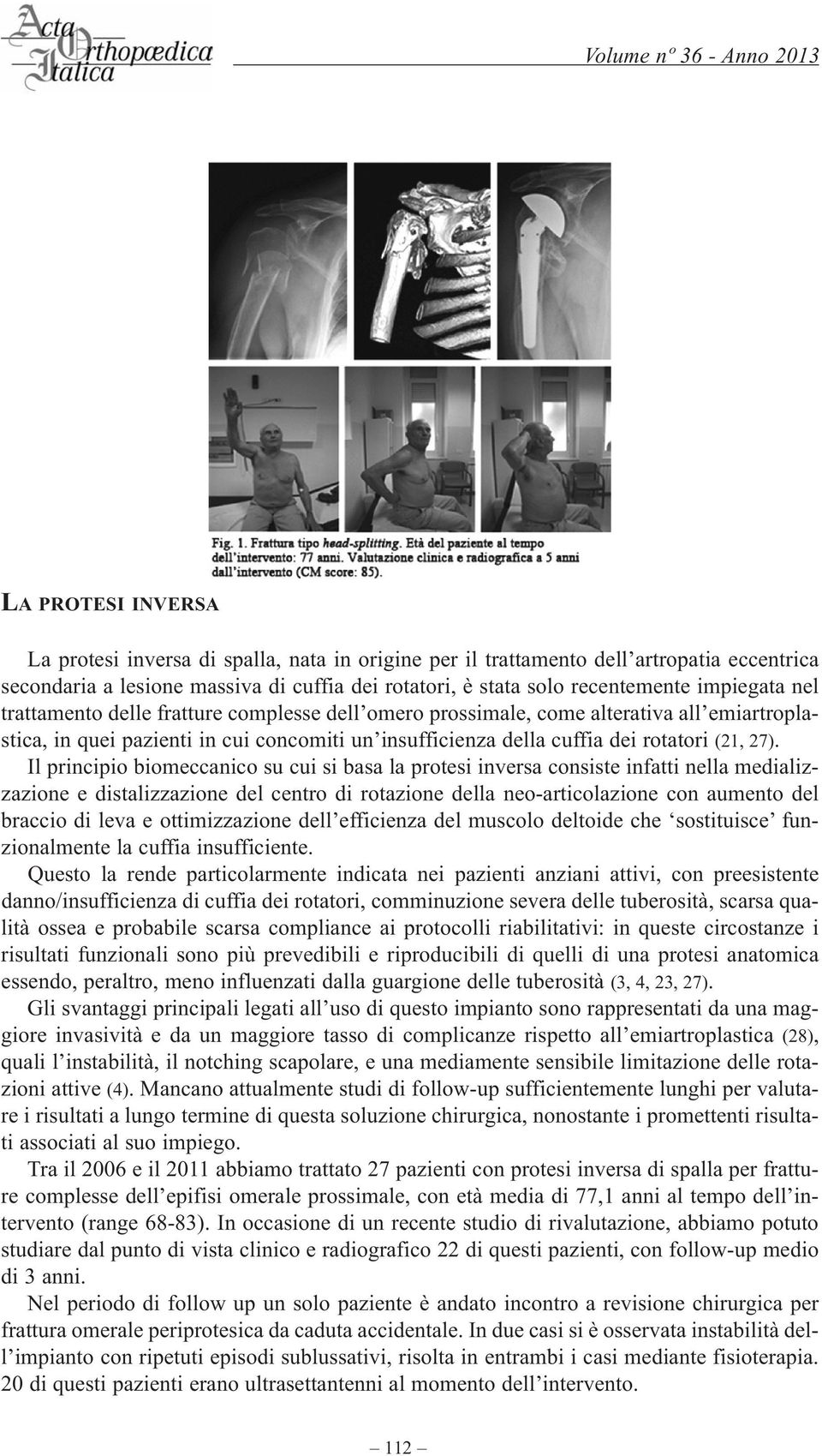 Il principio biomeccanico su cui si basa la protesi inversa consiste infatti nella medializzazione e distalizzazione del centro di rotazione della neo-articolazione con aumento del braccio di leva e