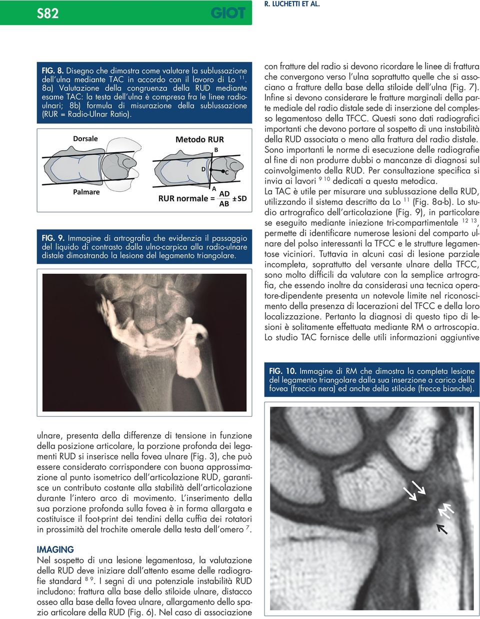 Immagine di artrografia che evidenzia il passaggio del liquido di contrasto dalla ulno-carpica alla radio-ulnare distale dimostrando la lesione del legamento triangolare.