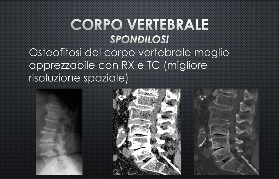 apprezzabile con RX e