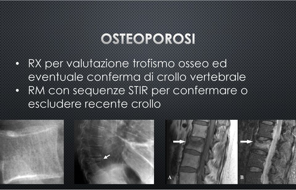 vertebrale RM con sequenze STIR