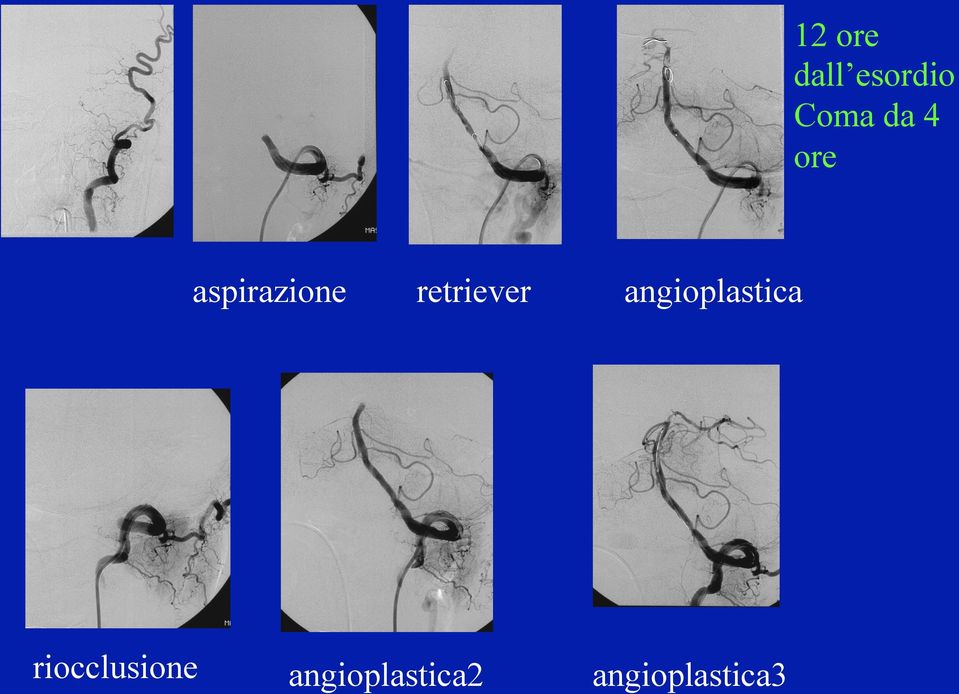 riocclusione retriever