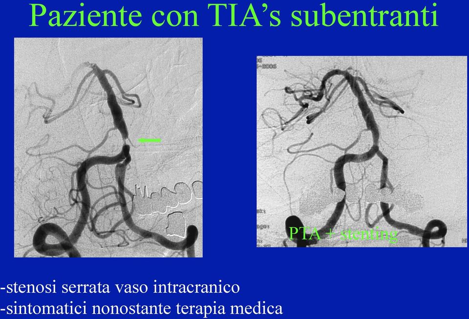 serrata vaso intracranico -