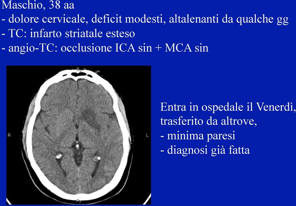 angio-tc: occlusione ICA sin + MCA sin Entra in ospedale il