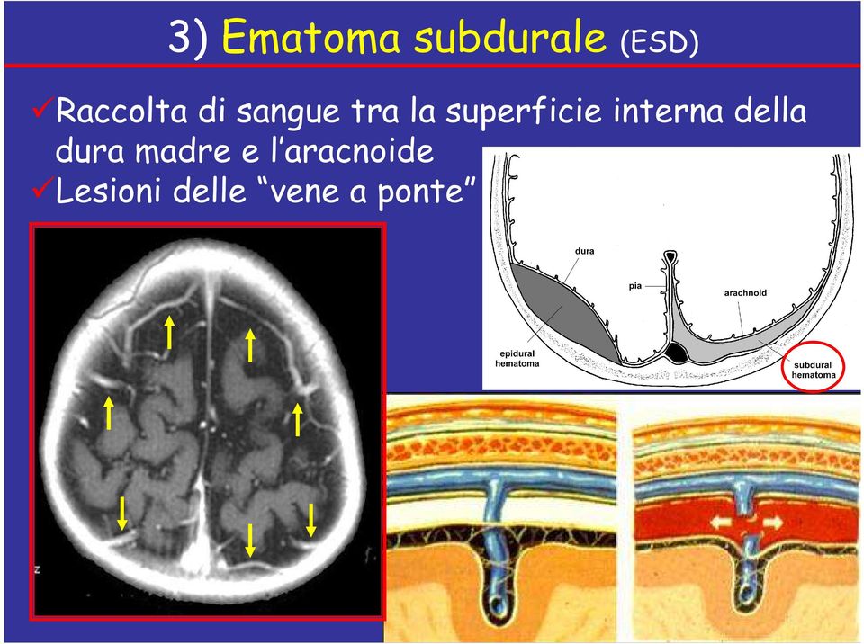 superficie interna della dura