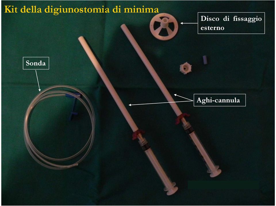 Needle catheter jejunostomy (NCJ: digiunostomia di minima) con tecnica sec. Seldinger.