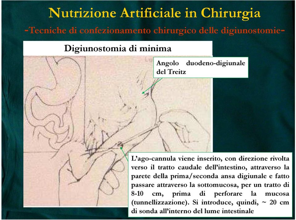 parete della prima/seconda ansa digiunale e fatto passare attraverso la sottomucosa, per un tratto di 8-10 cm,