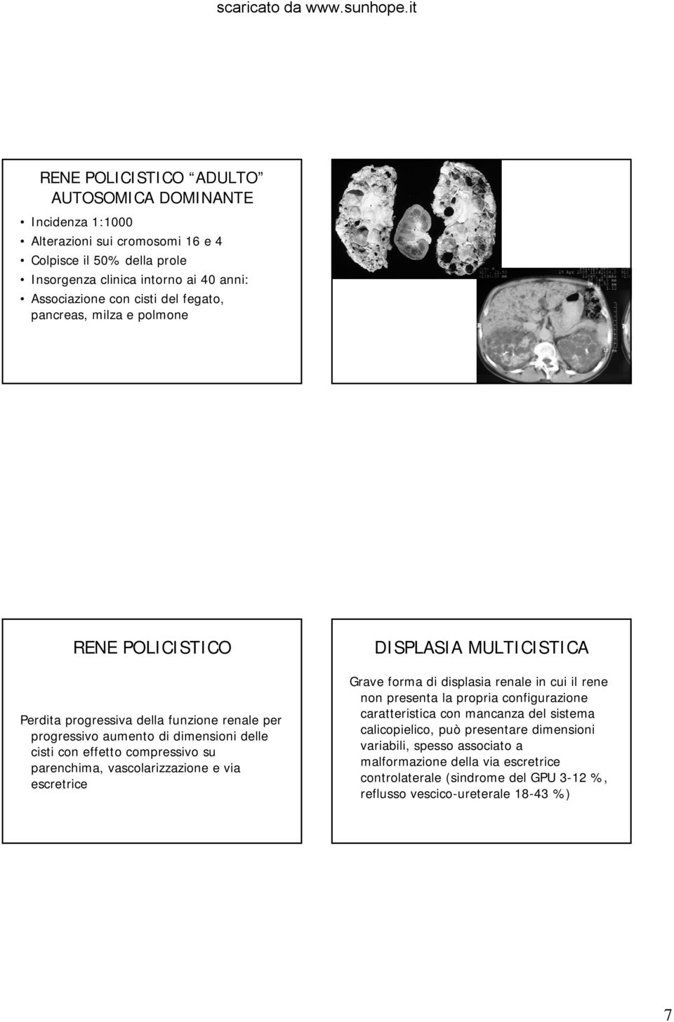 parenchima, vascolarizzazione e via escretrice DISPLASIA MULTICISTICA Grave forma di displasia renale in cui il rene non presenta la propria configurazione caratteristica con mancanza